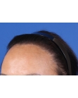 After Hair Transplant&nbsp;Hairline